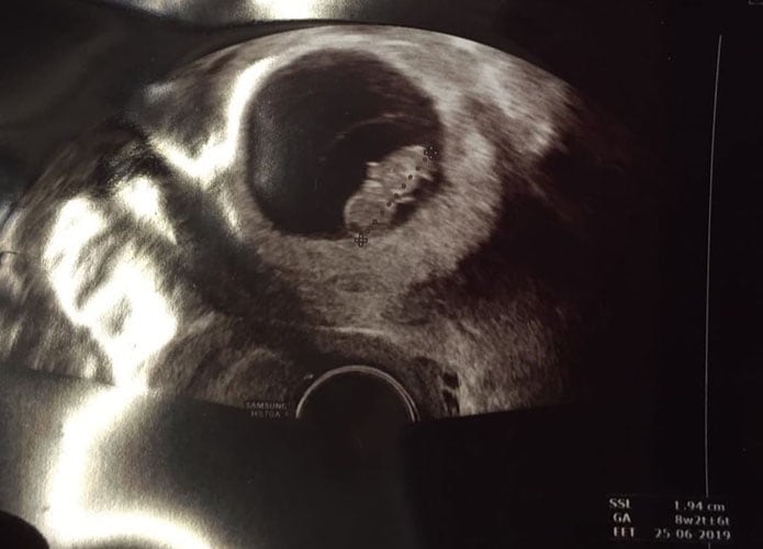 ultraschall 8 ssw junge
